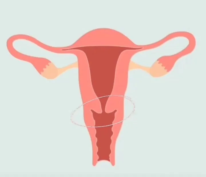 Se lahko menstrualna skodelica izgubi v meni?